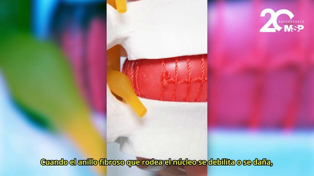 ¿Cómo se forma una hernia discal y qué tratamientos existen? - #EspecialMSP