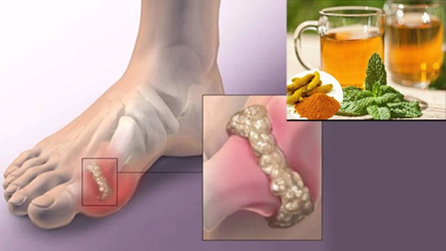 हल्दी और तुलसी से हाई यूरिक एसिड कम करने का तरीका | High Uric Acid Kaise Kam Karen | Boldsky