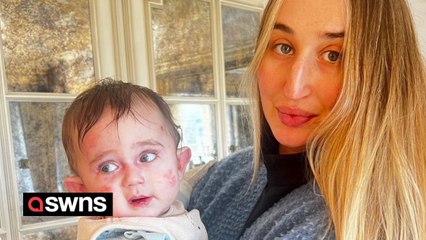 Meet the 10-month-old baby whose "butterfly" skin is so fragile he can be hurt by a gust of wind