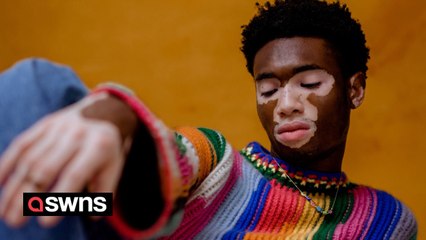 "I'm a model with vitiligo - people ask if my skin has been burned or is a Halloween costume"