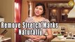 खिंचाव के निशानो के लिए घरेलु उपचार | How to Remove Stretch Marks Naturally By Priyanka Saini