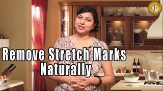 खिंचाव के निशानो के लिए घरेलु उपचार | How to Remove Stretch Marks Naturally By Priyanka Saini