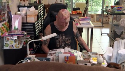 Researches say cannabis has 'deadly' effect on melanoma