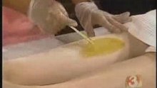 Laser Hair Removal Tutorial