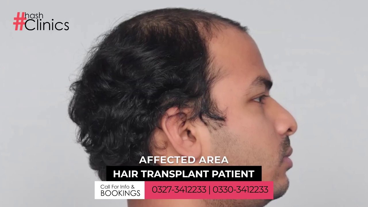Hair Transplant in Karachi _ Before & After Results