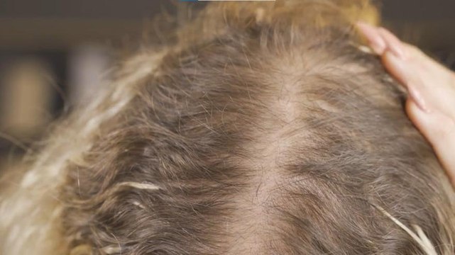 Mangiare bene può dare benefici anche per il cuoio capelluto: ecco cosa preferire a tavola