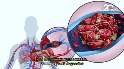 Complicación cardíaca del lupus: Infarto agudo de miocardio - #EspecialMSP