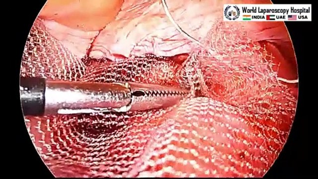 Laparoscopic Pectopexy for Apical Uterine Prolapse_ Satisfactory Minimal Access Surgical Approach