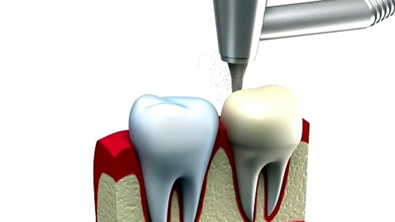 Crowning Glory A Guide to Dental Crowns video Dailymotion