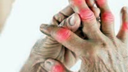 10 Lesser Known Rheumatoid Arthritis Symptoms  #rheumatoidarthritis #symptoms #treatment #beauty