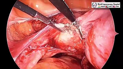 Total Laparoscopic Hysterectomy for Large Lateral Wall Fibroid Uterus