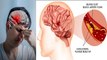 Headache Stroke Symptoms In Hindi, Signs Treatment Risk Warning Detail Video|Boldsky