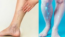 पैर की नस ब्लॉक होने के लक्षण क्या है|Symptoms Of Blocked Leg Veins In Hindi|Boldsky