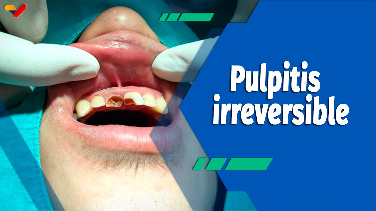 Actitud Saludable | Pulpitis irreversible, causas y tratamientos