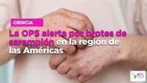 La OPS alerta por brotes de sarampión en la región de las Américas