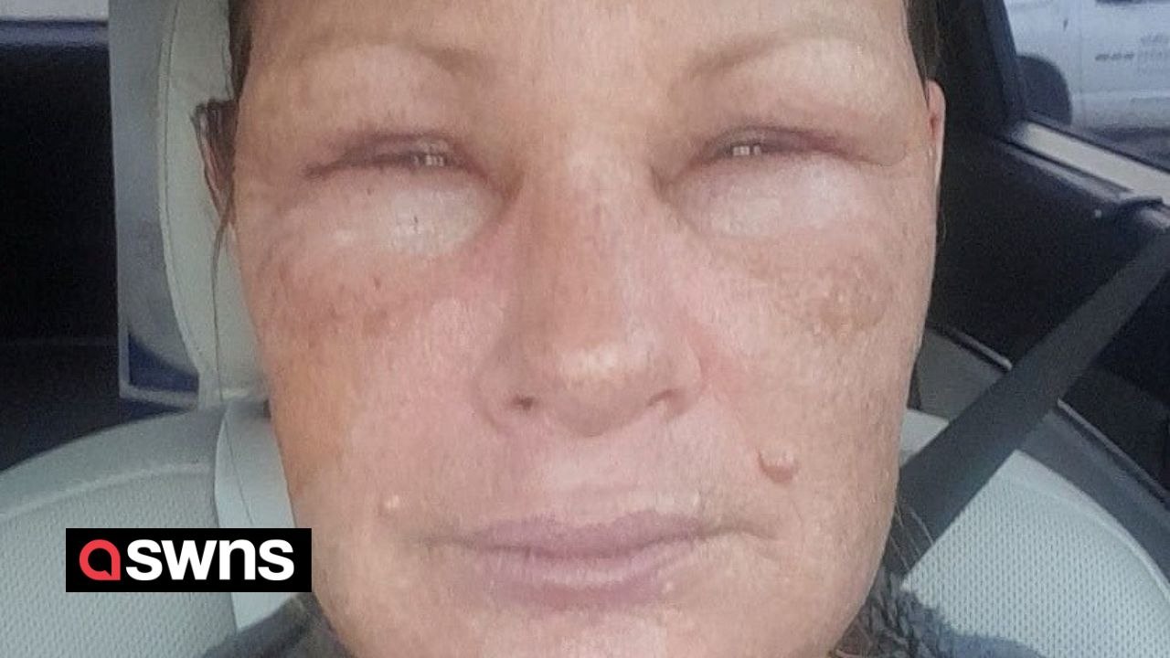 Woman suffers burns when her pressure cooker exploded while cooking soup