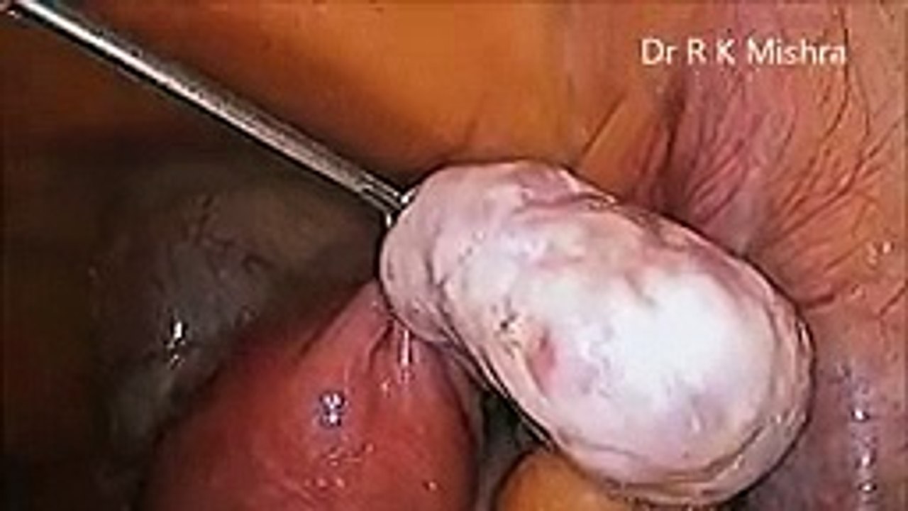 Ovarian Drilling by Laparoscopy for PCOS
