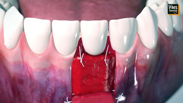 చిగురు సమస్యలకు Bone Grafting ఎలా ఉపయోగపడుతుంది ? | Types of బోన్ గ్రాఫ్టింగ్ ? | FMS Dental