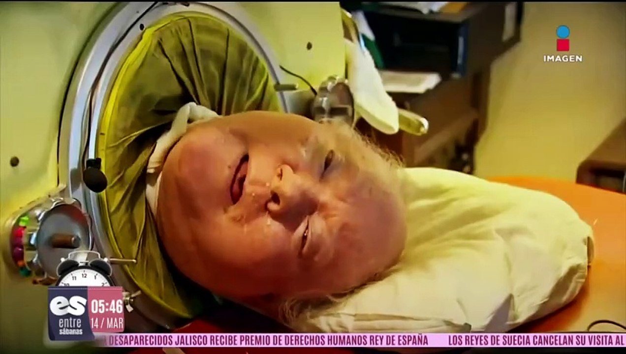 Muere Paul Alexander, hombre que pasó 7 décadas dentro de una cápsula de hierro