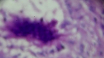 Tödlichste Infektion der Welt: Immer mehr Fallzahlen in Deutschland