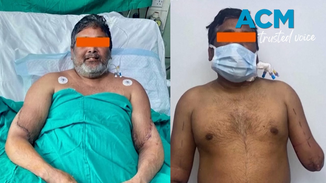 Painters gets two new hands in double transplant