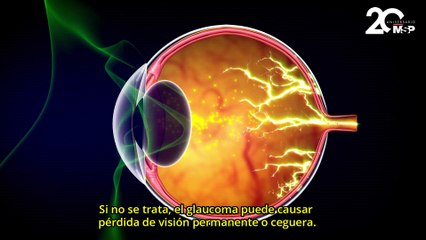 Glaucoma: ¿Qué es y cómo afecta la salud de los ojos? - #DíaMundial