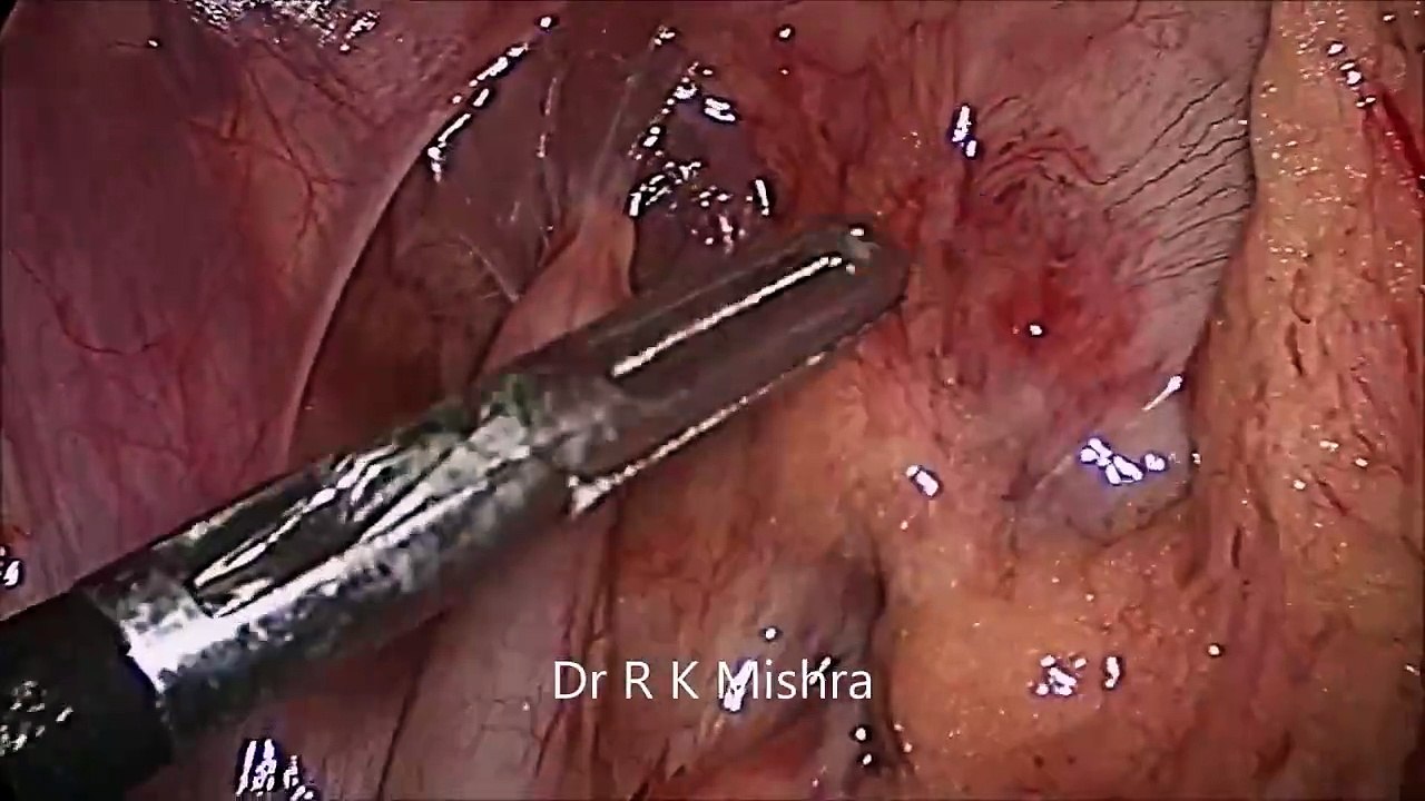 Appendectomy by Mishra's Knot