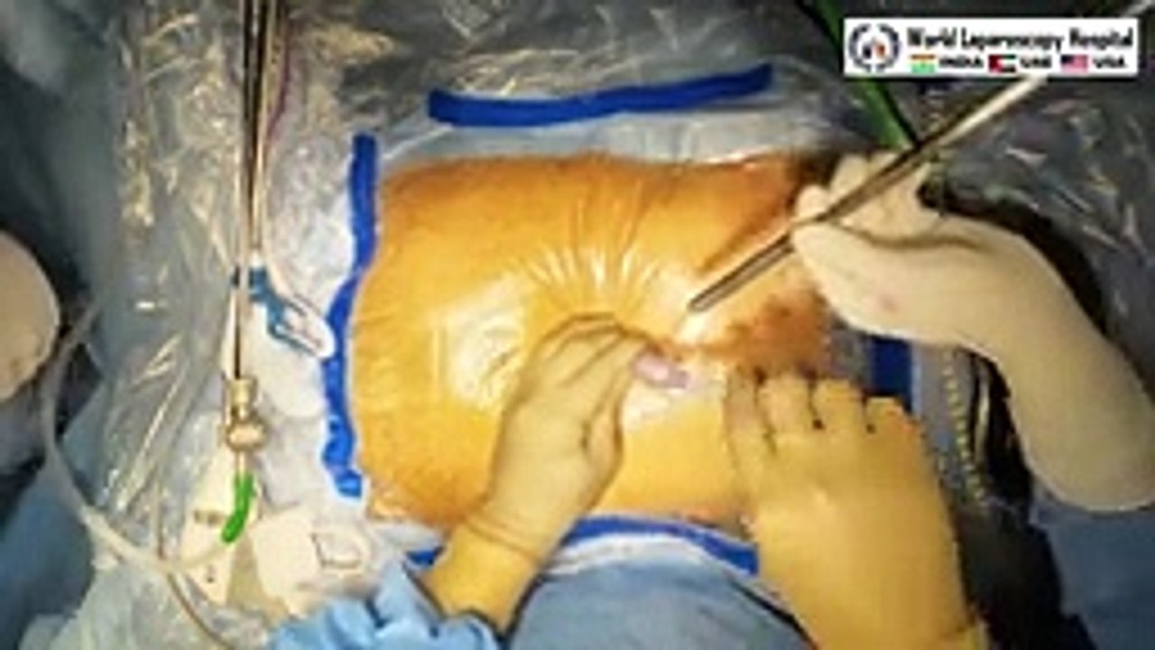 Total Laparoscopic Hysterectomy with Right Inguinal and Left Incisional hernia repair by three-port