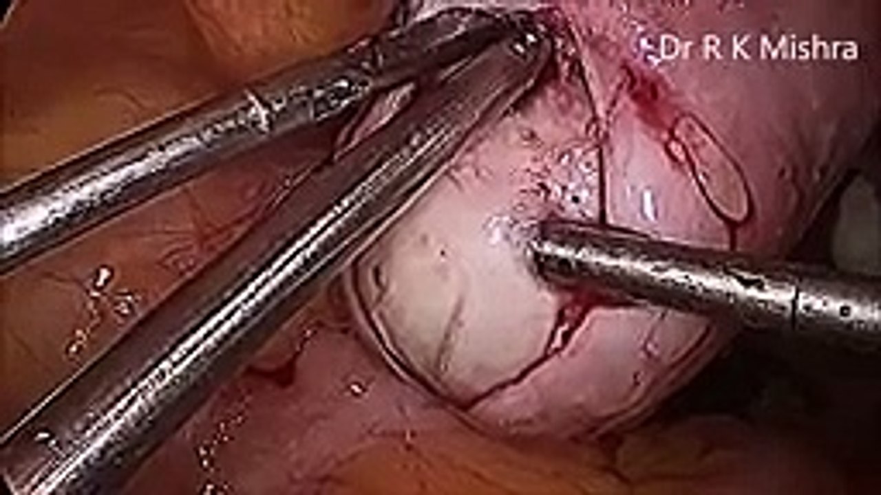Myomectomy Surgery for Fibroid Uterus