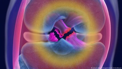 تمزق الرباط الصليبي ـ هل تساعد التمارين؟