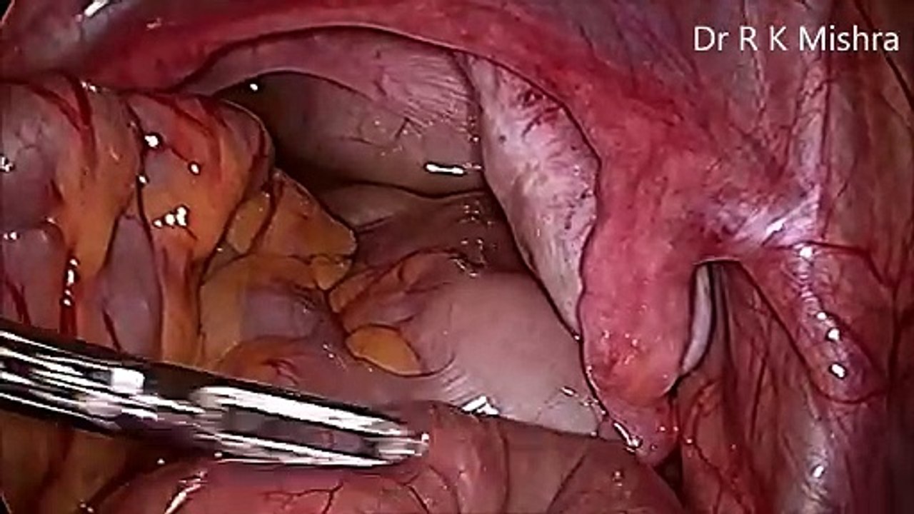 Appendicectomy for Appendicitis in child - Pediatric Appendix