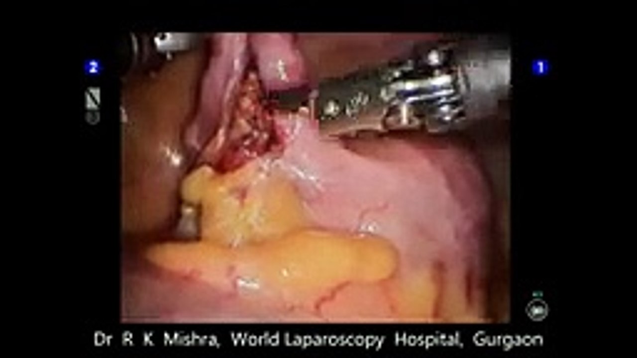 da Vinci Robotic Appendicectomy by Dr R K Mishra