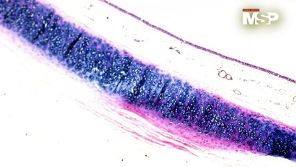 Endometriosis: ¿Cómo funciona a nivel celular y cómo afecta los tejidos? - #ExclusivoMSP