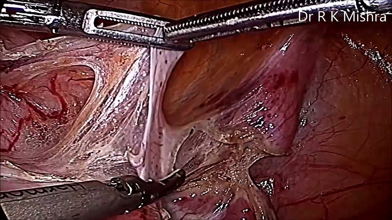 Basic Steps of Hysterectomy