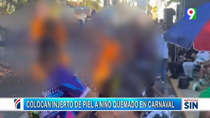 Colocan injerto de piel a niños afectados en carnaval de Salcedo   | Emisión Estelar SIN