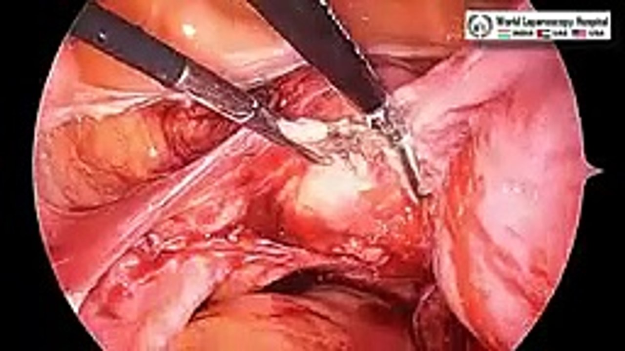 Total Laparoscopic Hysterectomy for Large Lateral Wall Fibroid Uterus