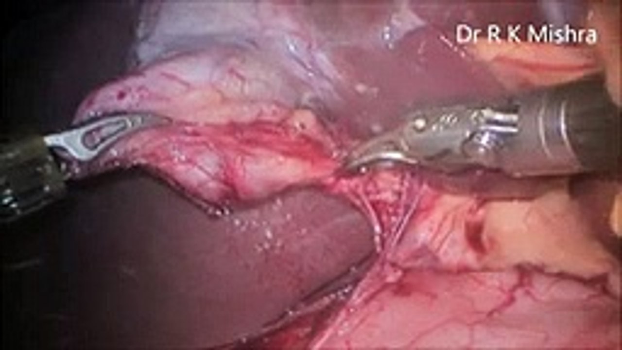 Robotic Cholecystectomy by Dr. R. K. Mishra (1)