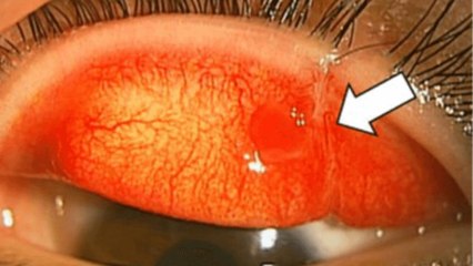 Il est attaqué par un chien et perd la vision d'un œil.