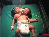 Nace bebé con dos cabezas en India