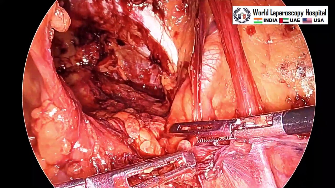 Bilateral Inguinal (Groin) Hernia Surgery