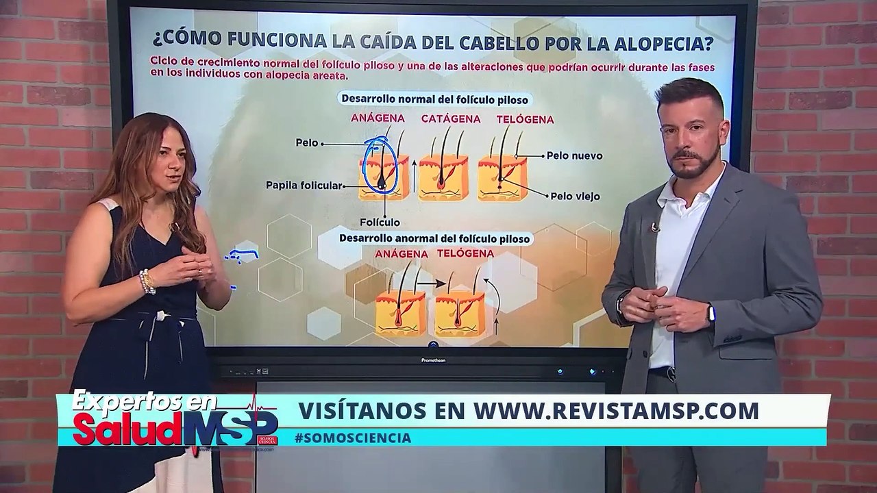 Caída del cabello o alopecia por alteraciones en la tiroides - #ExclusivoMSP