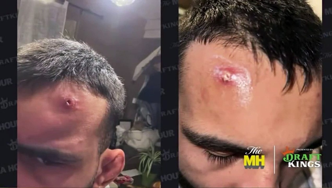 Benoît Saint Denis a partagé des photos de son staphylocoque avant son combat face à Dustin