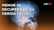 Se recupera de una bala perdida y sus padres decidieron no quitarle el proyectil