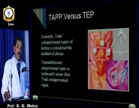 Laparoscopic Hernia Repair TAPP