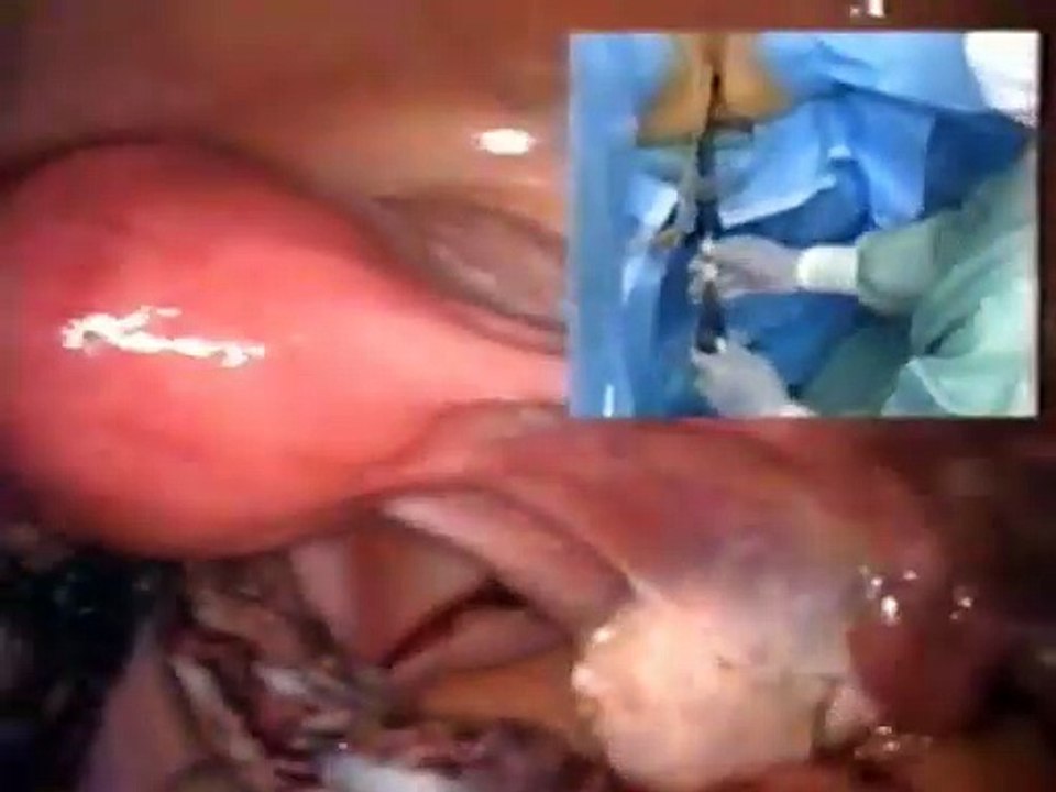 Laparoscopic Hysterectomy(1)