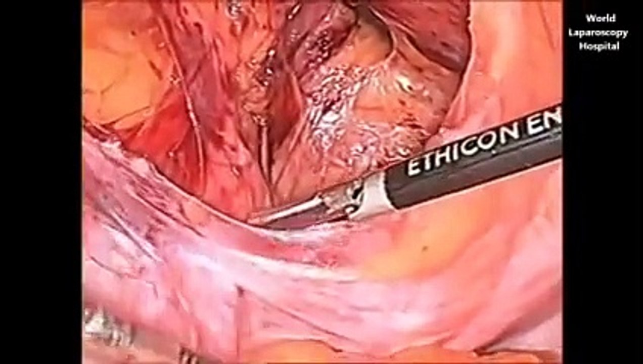 TAPP Laparoscopic Hernia Surgery