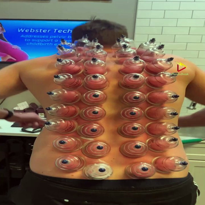 Truth About Cupping Therapy: Separating Fact from Fiction #fundubook #cuppingtherapy #cuppingmassage