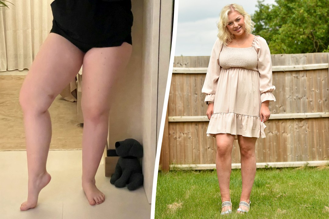 "I was fat-shamed by trolls for having tree trunk legs so paid £20k to get similar surgery to Love Island star"