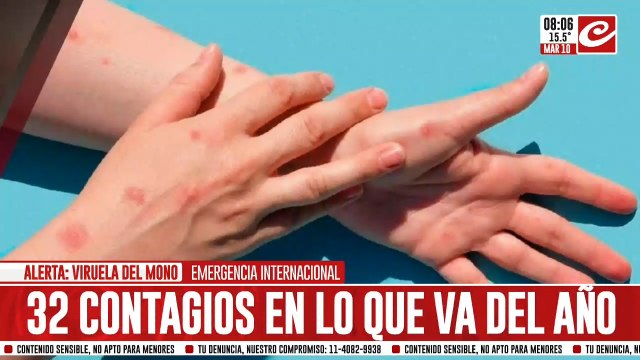 Alerta por la viruela del mono: se aceleran los contagios en el país