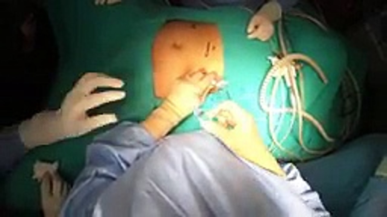 Laparoscopic Myomectomy for Large Intramural Fibroid Uterus